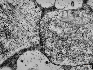 M, 1y. | gangliosidosis - liver